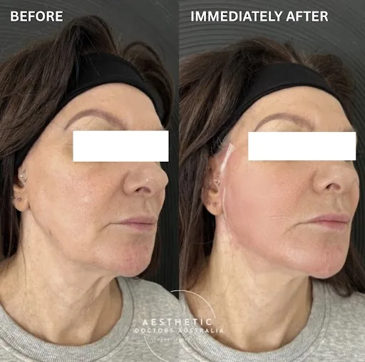 Before and immediately-after composite of a PDO thread lift showing a lifted jawline contour, eyes masked for privacy