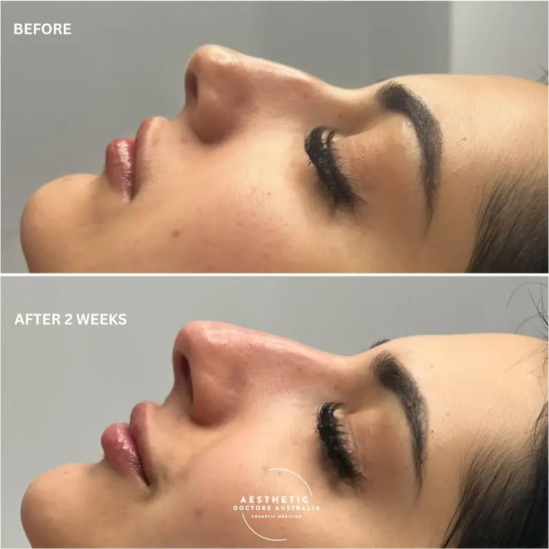 Reclined before and after composite showing a straightened bridge contour
