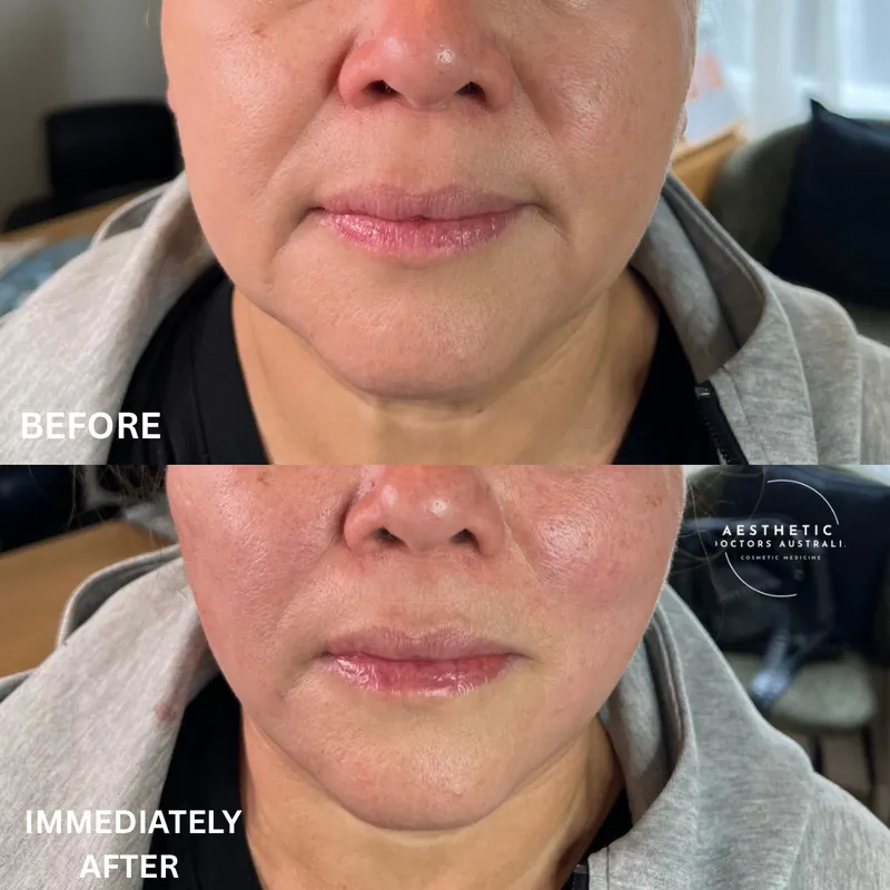 Before and immediately after composite following a PDO thread lift through the lower face