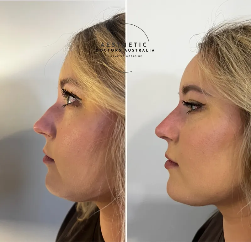 Before and after composite in profile following non-surgical rhinoplasty