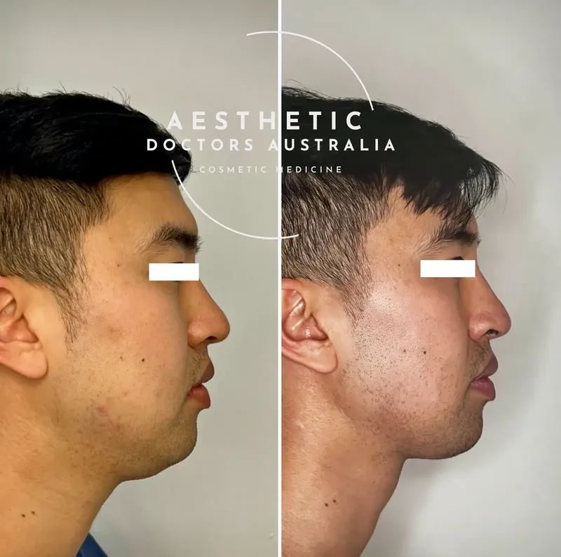 Before and after composite in profile after four sessions of fat dissolving treatment beneath the chin