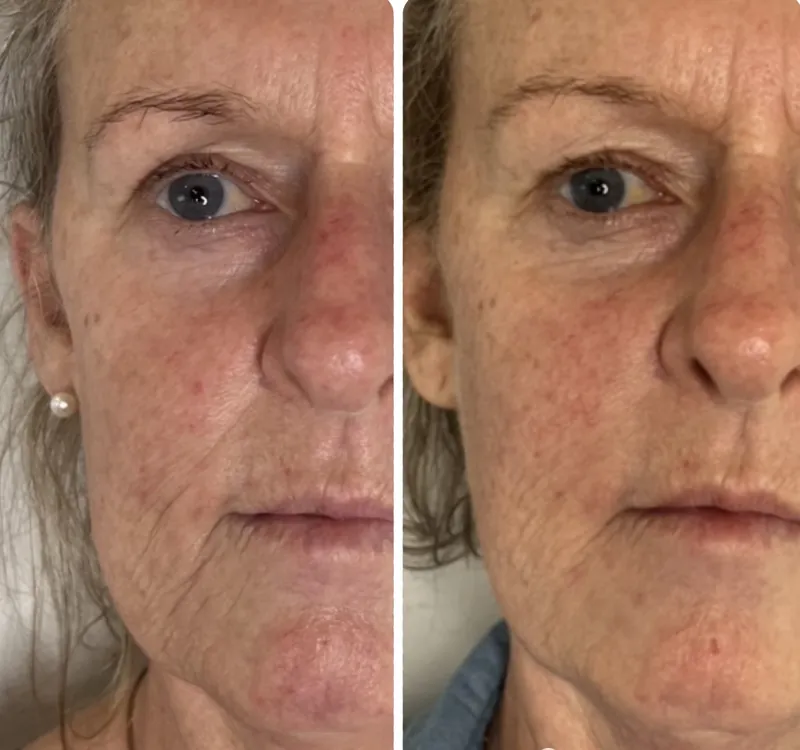 Close before and after composite of the cheek and under-eye showing improved skin texture