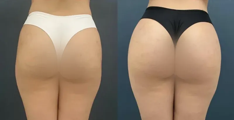 Before and after composite of hip dip treatment showing a smoother outer hip line