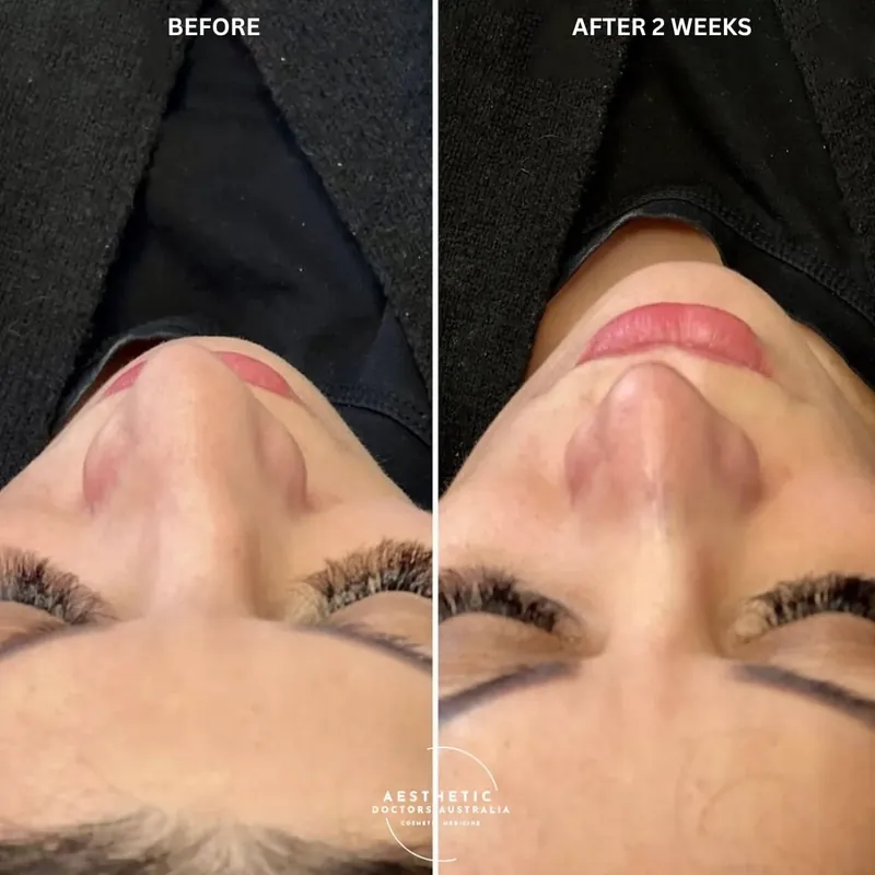 Base-view before and after composite showing improved nasal tip symmetry two weeks after non-surgical rhinoplasty