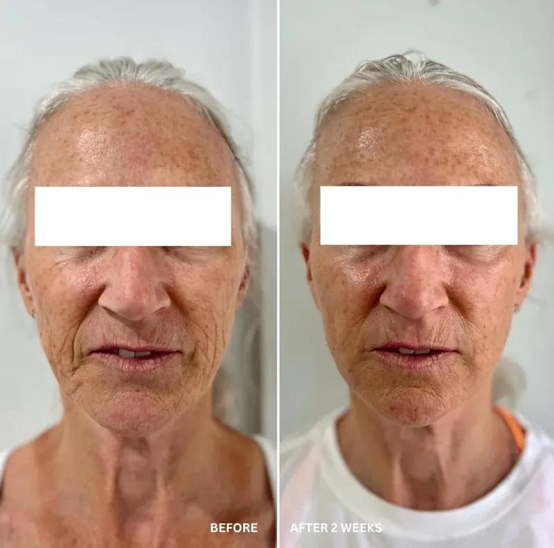 Front-on before and after composite of a male patient, eyes masked for privacy, showing firmer-looking skin across the face and neck