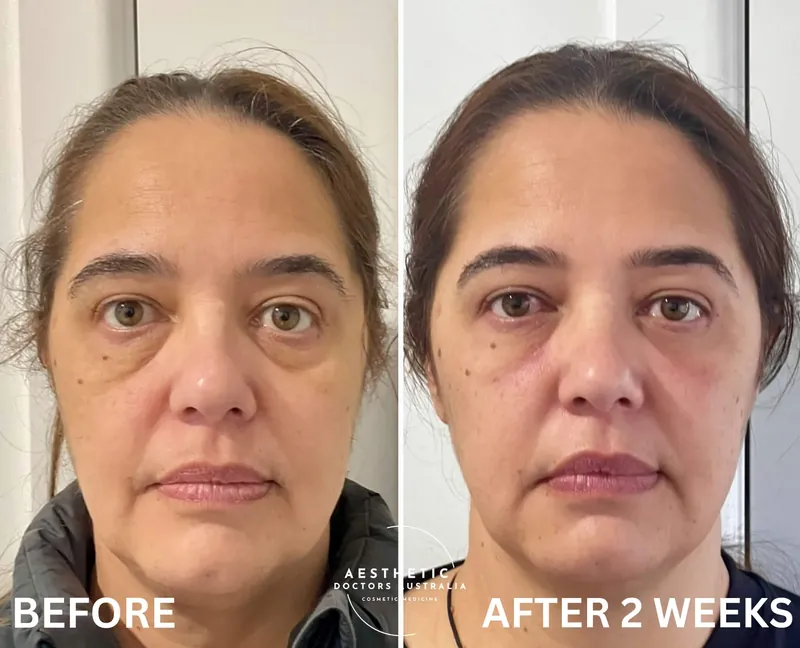 Front-on before and after composite showing balanced, refreshed facial proportions two weeks after a planned full-face treatment