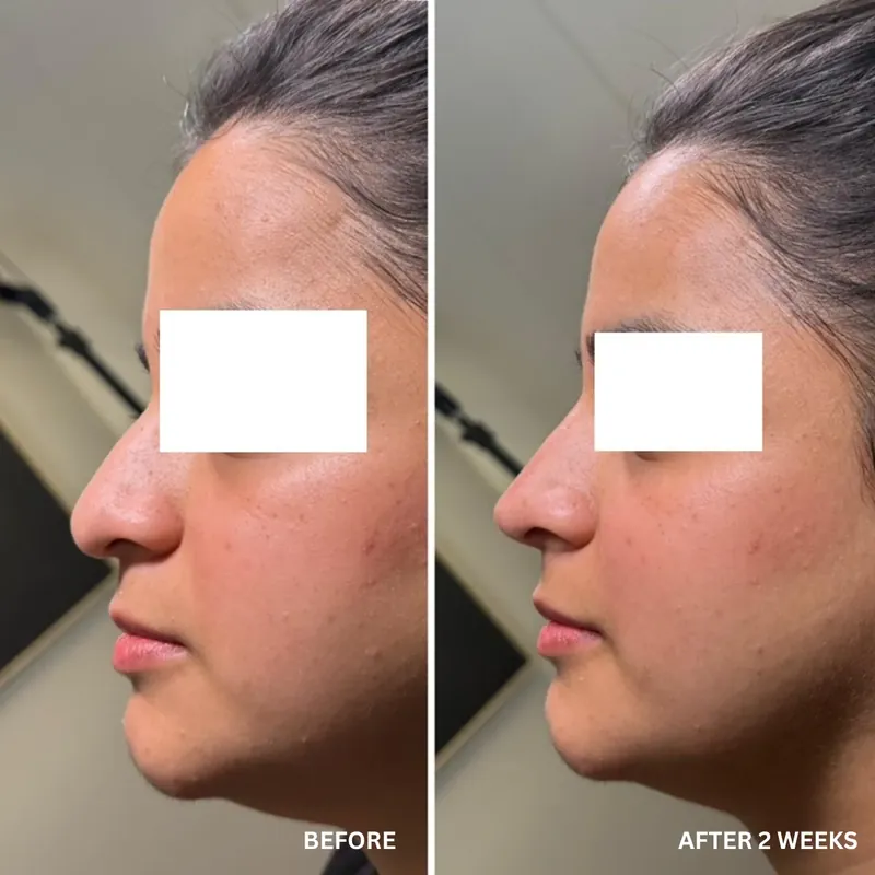 Profile before and after composite, eyes masked for privacy, showing a smoothed dorsal line and lifted tip two weeks after treatment