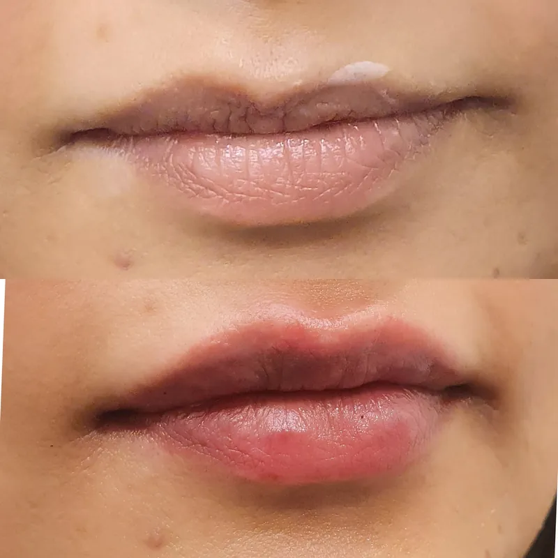 Close before and after composite of the lips following volume enhancement