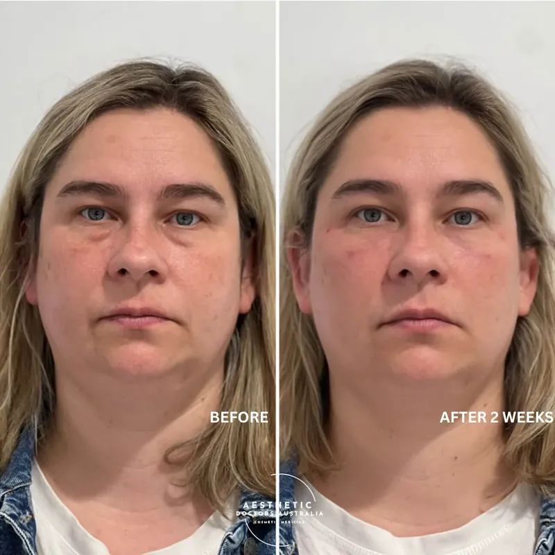 Front-on before and after composite showing smoother, less shadowed under-eye contours two weeks after treatment