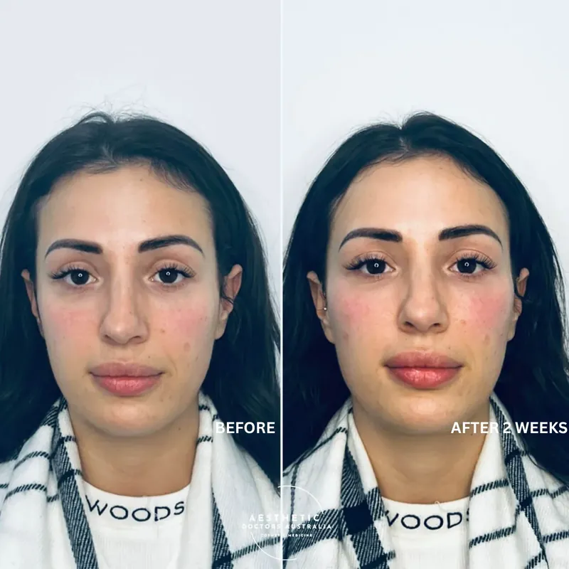 Front-on before and after composite showing softened tear-trough shadows