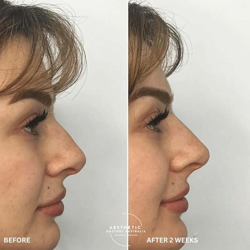 Close profile before and after composite showing a smoother, more even bridge contour