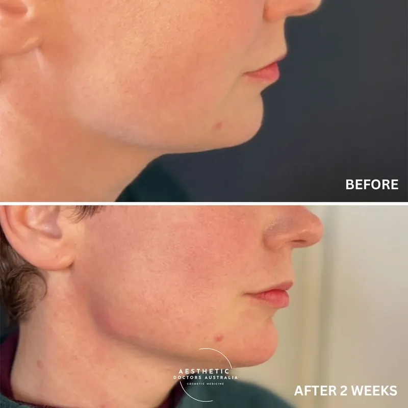 Profile before and after composite showing a clearer chin-to-neck transition