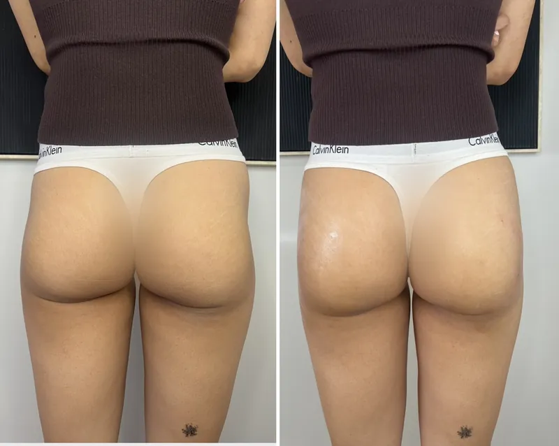 Before and after composite of a conservatively treated outer hip contour