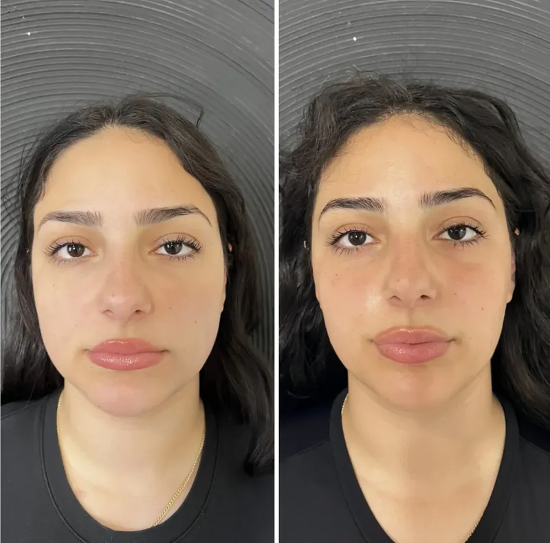 Before and after composite of masseter face-slimming treatment showing a slimmer lower face on front view