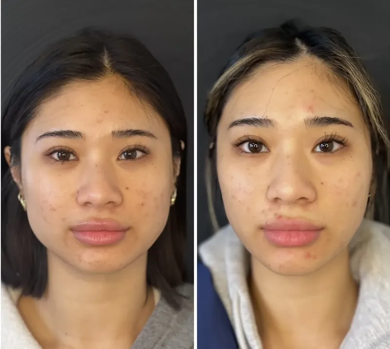 Before and after composite of masseter treatment showing softer lower-face width on front view