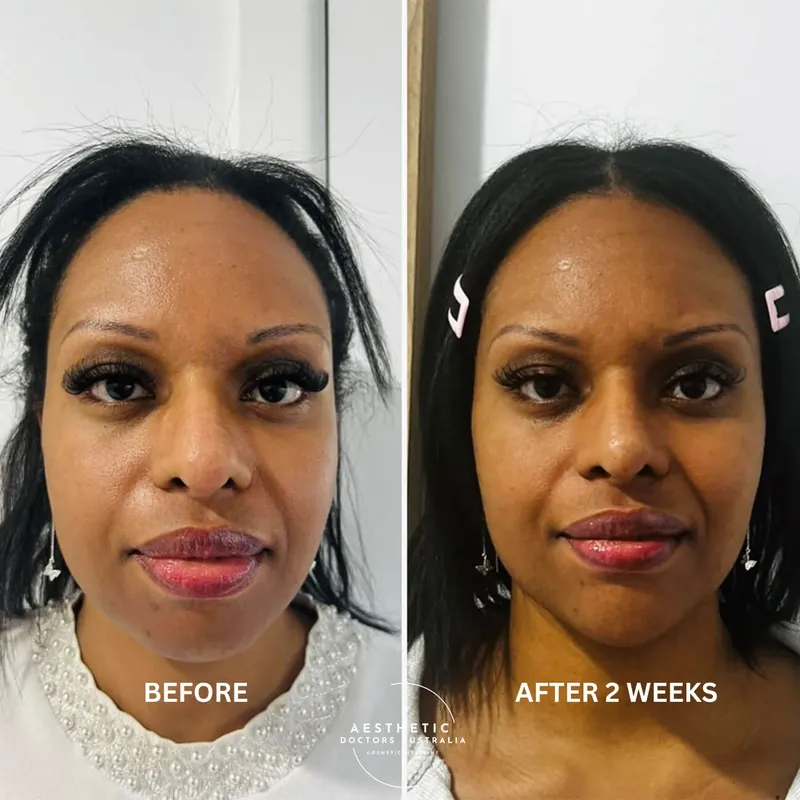 Front-on before and after composite showing improved lower-face balance and chin support two weeks after jawline treatment