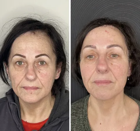 Front-on before and after composite following cheek and under-eye rejuvenation