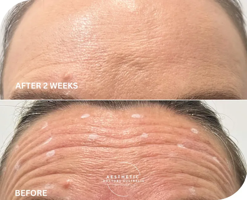 Close before and after composite showing smoothed horizontal forehead lines two weeks after treatment