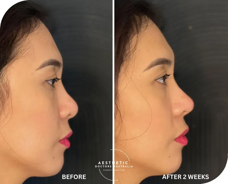 Profile before and after composite showing a lifted, better supported nasal tip two weeks after non-surgical rhinoplasty