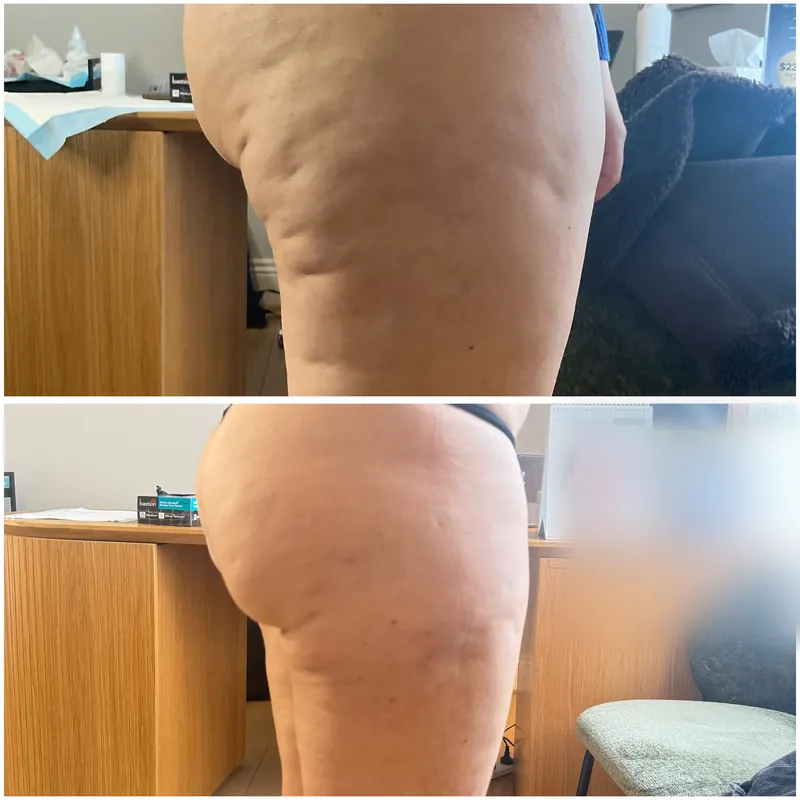 Cellulite dimpling through the buttock and upper thigh before and after subcision with a collagen biostimulator
