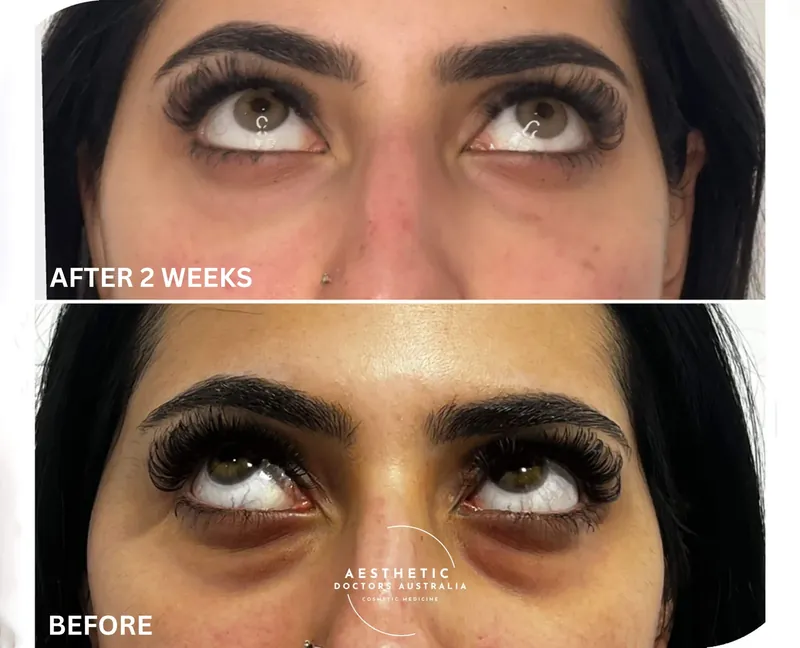 Before and after composite on upward gaze showing reduced dark circles and restored under-eye volume
