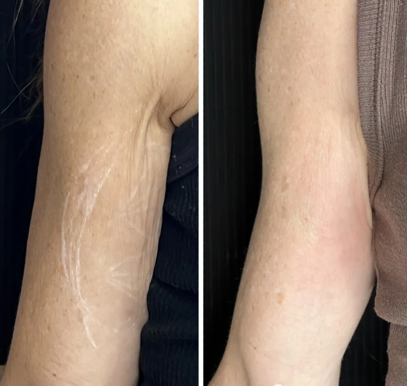 Before and after composite of the upper arm following collagen biostimulator treatment for skin laxity