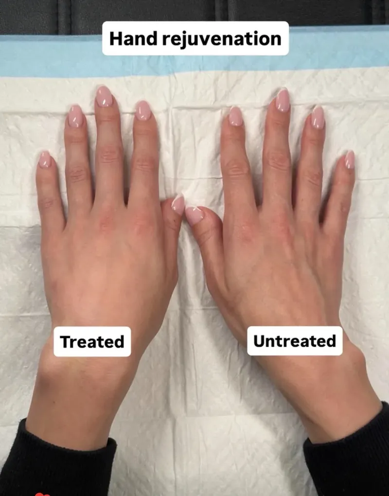 Composite showing one hand treated with collagen biostimulator beside the untreated hand for comparison