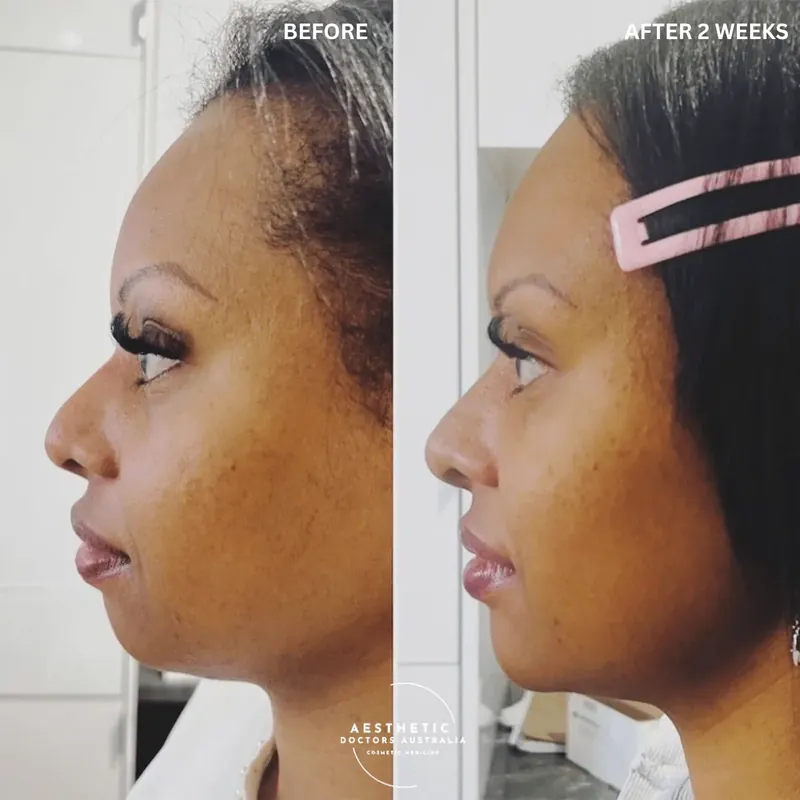 Profile before and after composite showing improved bridge height and tip definition