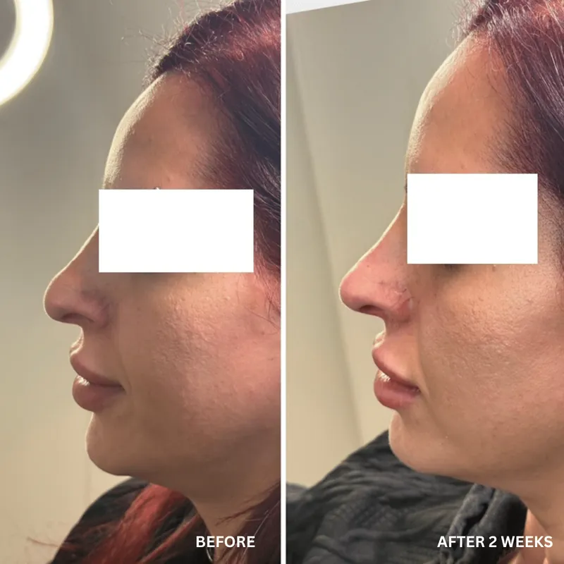 Non-surgical rhinoplasty refining the bridge profile by camouflaging a small dorsal hump