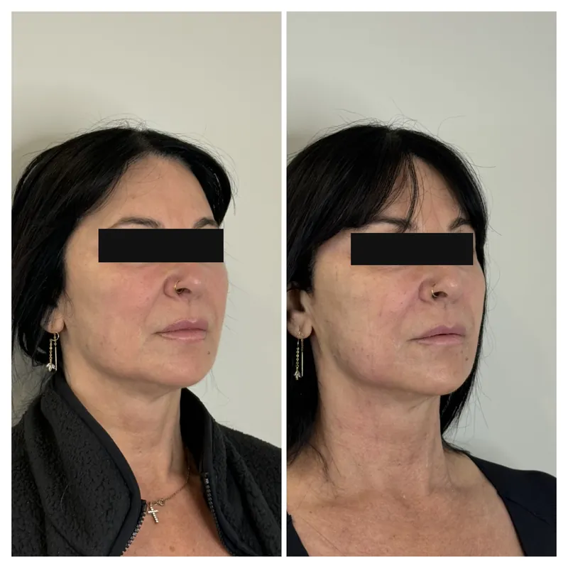 Before and after composite following XERF skin tightening through the cheek, jawline and neck