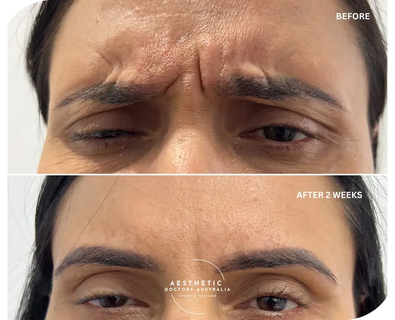 Before and after composite showing softened vertical frown lines between the brows