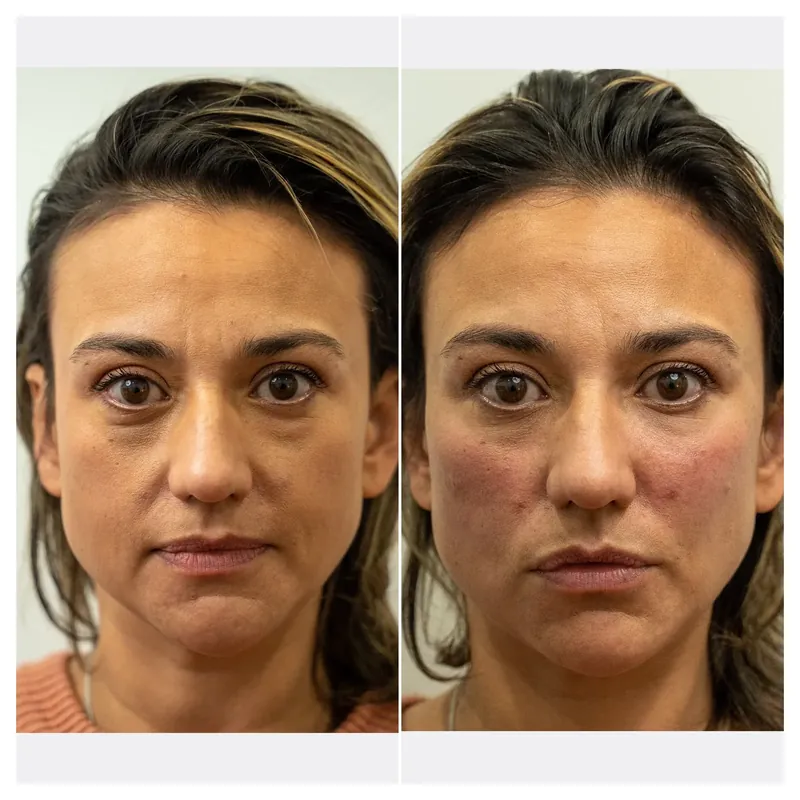 Before and after composite of cheek volume enhancement showing restored cheek contour on front view