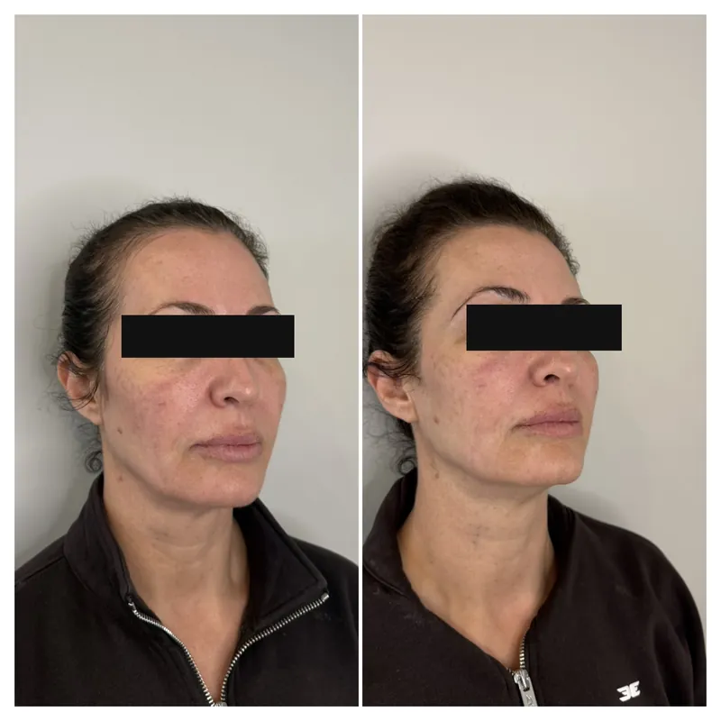 Before and after composite following XERF skin tightening through the lower face