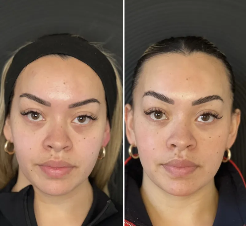 Front-on before and after composite following under-eye rejuvenation