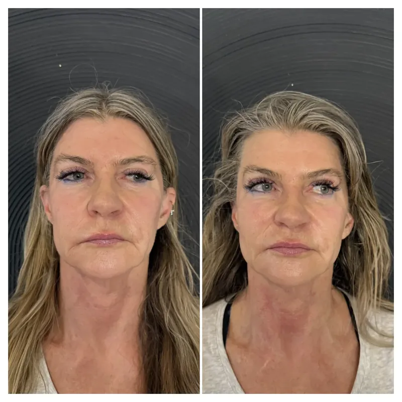 Before and after composite of XERF skin tightening showing firmer facial contours on front view