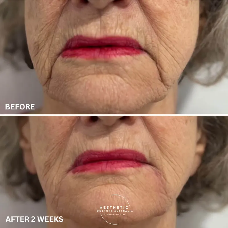 Before and after composite showing treatment of the marionette line and the corner of the mouth