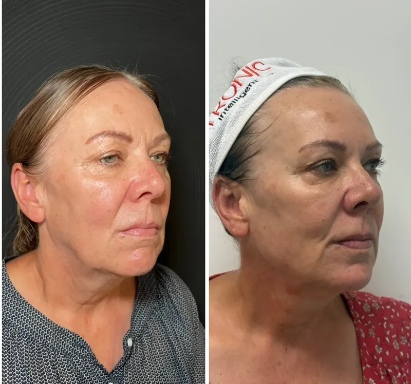 Before and after composite of XERF skin tightening showing improved lower-face firmness in profile