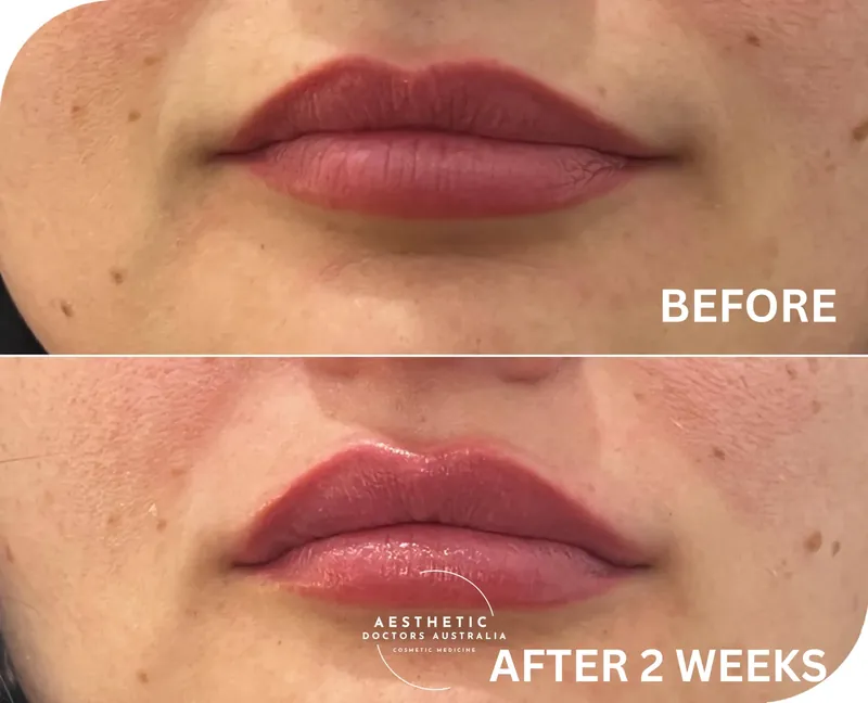 Close before and after composite of lip volume enhancement treatment showing fuller, well defined lips