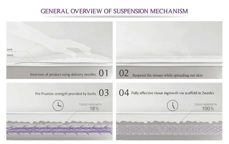 Cheek lift PDO thread placement detail at Aesthetic Doctors Australia