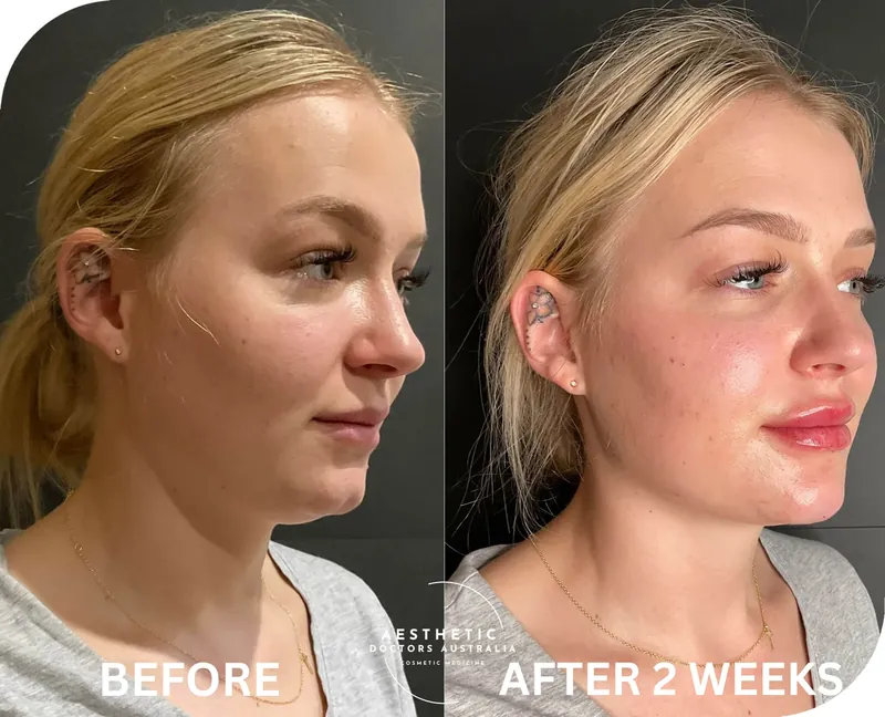 Before and after composite of full face rejuvenation showing restored mid-face volume and better chin support