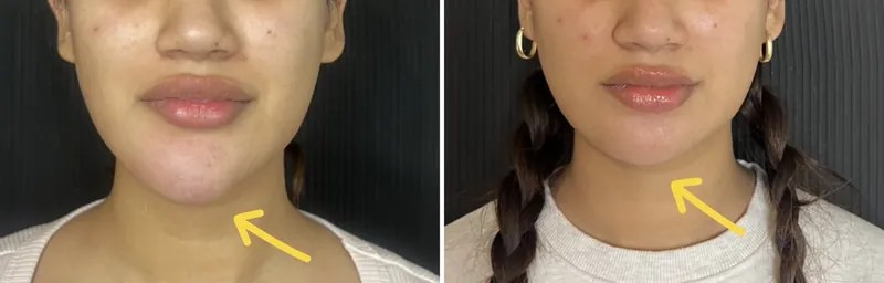 Before and after composite of the chin and jawline following ultrasound-guided dissolving of migrated product