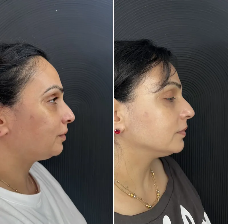 Before and after composite in profile after jawline contouring with volume enhancement