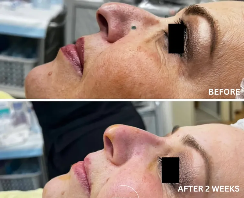 Before and after composite in profile following PDO nose thread treatment to support a droopy nasal tip