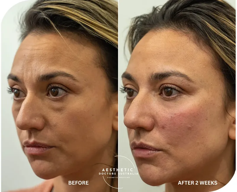 Before and after composite of under-eye treatment showing reduced hollowing and a brighter under-eye area