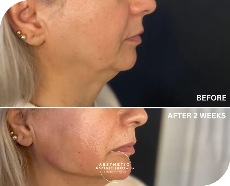 Before and after composite in profile showing restored definition along the lower jaw