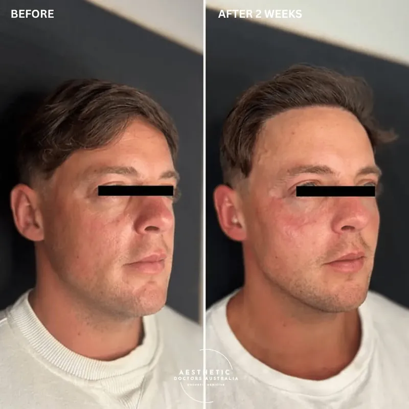 Before and after composite of a male patient, eyes masked for privacy, showing restored under-eye and cheek volume