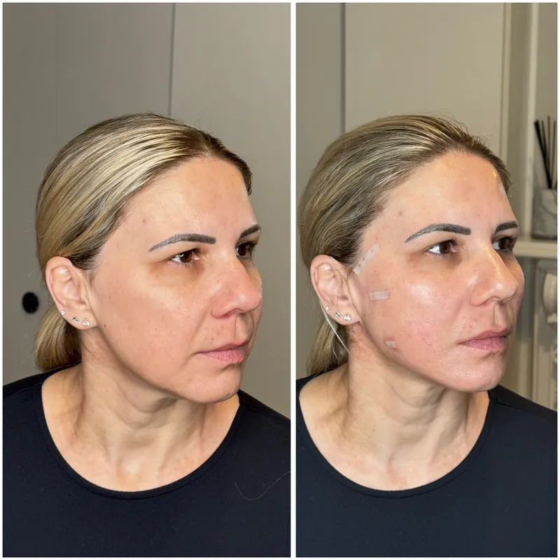 Before and after composite following a PDO thread lift along the jawline