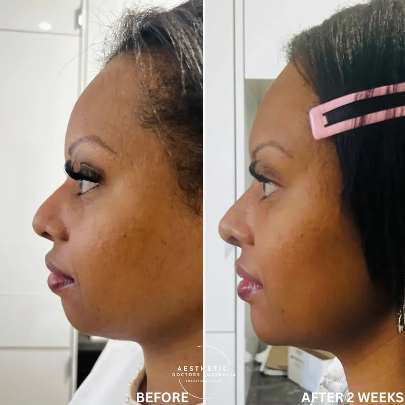 Before and after composite in profile following nose and chin correction to balance the side profile