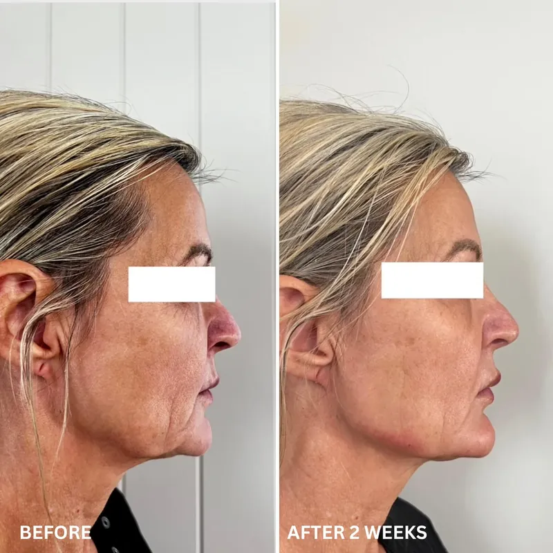Before and after composite in profile following a combination of biostimulator and volume enhancement along the jawline