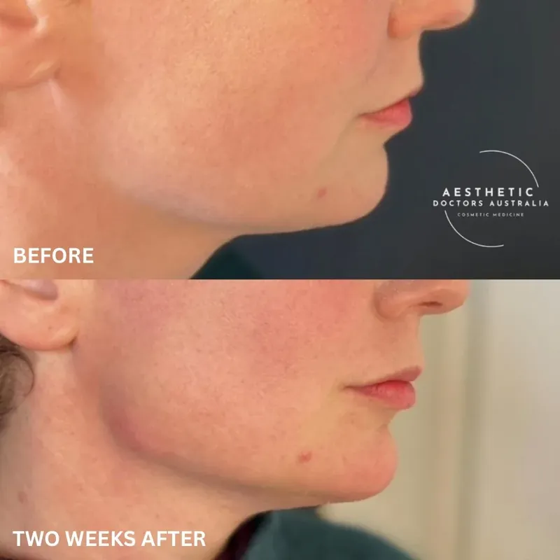 Close before and after composite showing smoother, firmer-looking skin along the cheek and jaw two weeks after collagen biostimulator treatment
